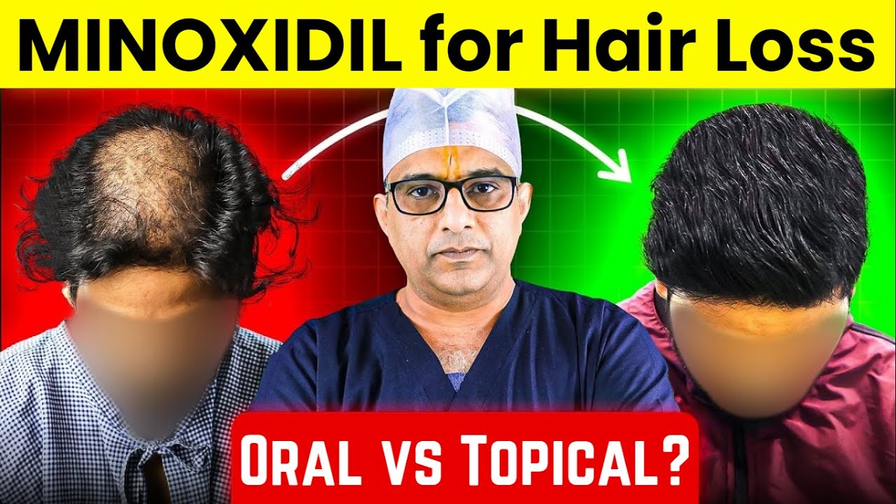 MINOXIDIL for Hair Loss - Oral vs Topical? Best Results Recommended by Dr. Satya Saraswat