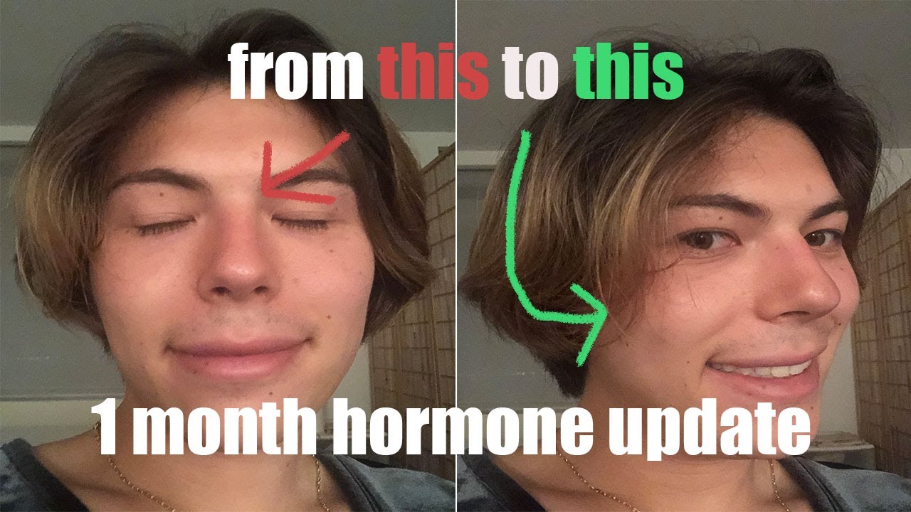 low dose estrogen hrt 1 month update (bicalutamide and estradiol)