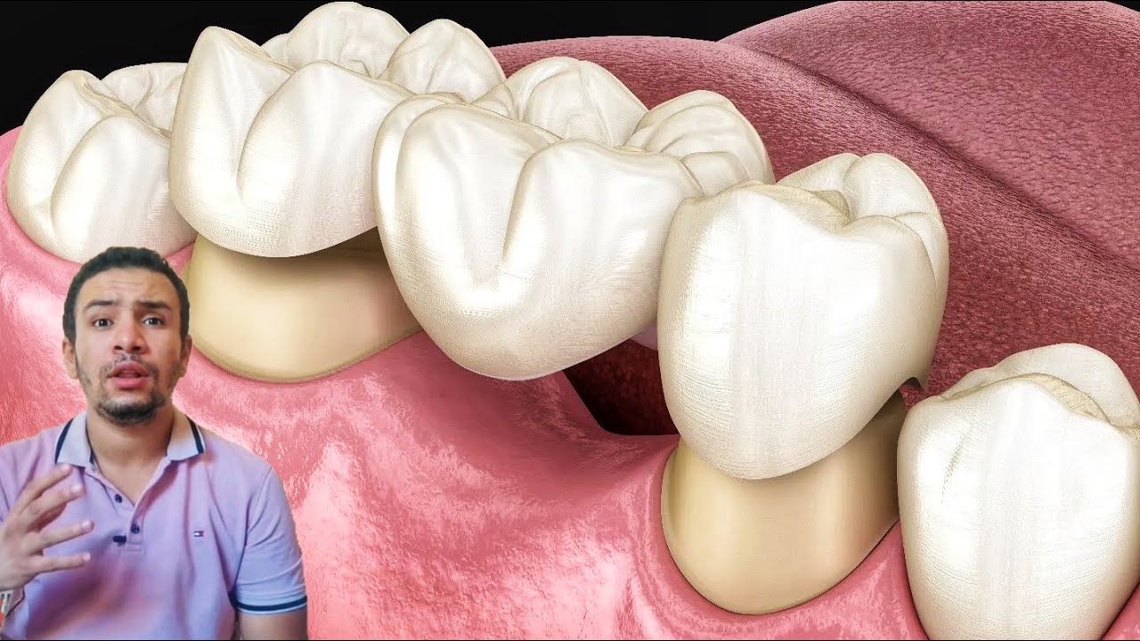 كيف تتعود سريعاً علي تركيبه الاسنان الثابته الجديده
