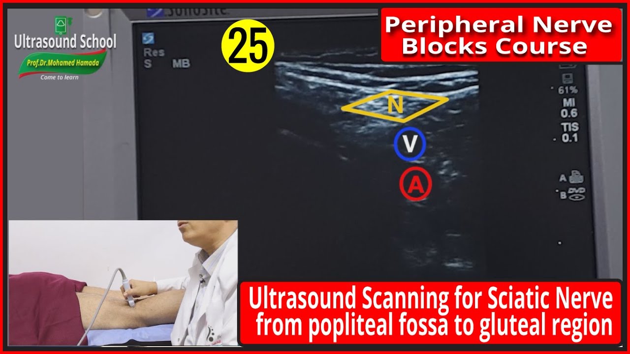 Popliteal Sciatic Nerve Block (Ultrasound Scanning Technique) |Mohamed Hamada|(25