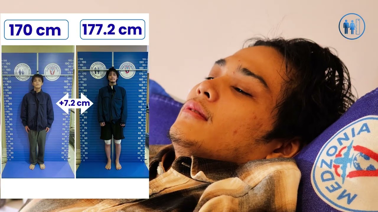 Wie verläuft die Physiotherapie nach einer Beinverlängerungsoperation? | Echte Aufnahmen