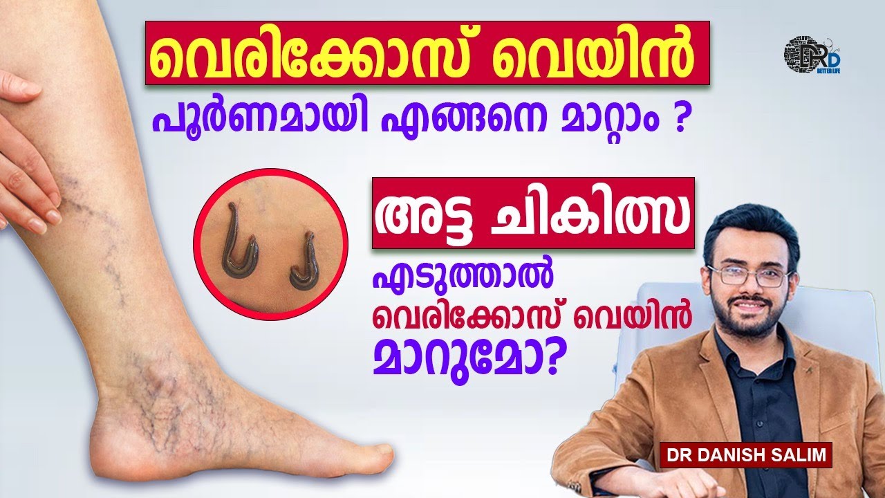 1289:🦵വെരിക്കോസ് വെയിനിന് ഫലപ്രദമായി എങ്ങനെ മാറ്റാം ? അട്ട ചികിത്സ എടുത്താൽ വെരിക്കോസ് വെയിൻ മാറുമോ?