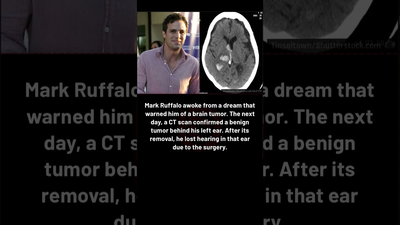Mark Ruffalo says he was diagnosed with a brain tumor after dreaming about it #markruffalo #marvel