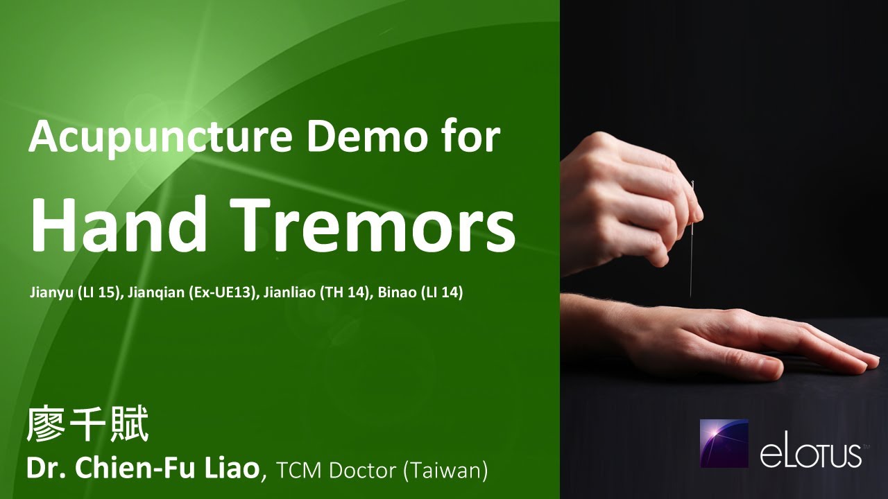 Acupuncture Demo For Hand Tremors by Dr. Chien-Fu Liao