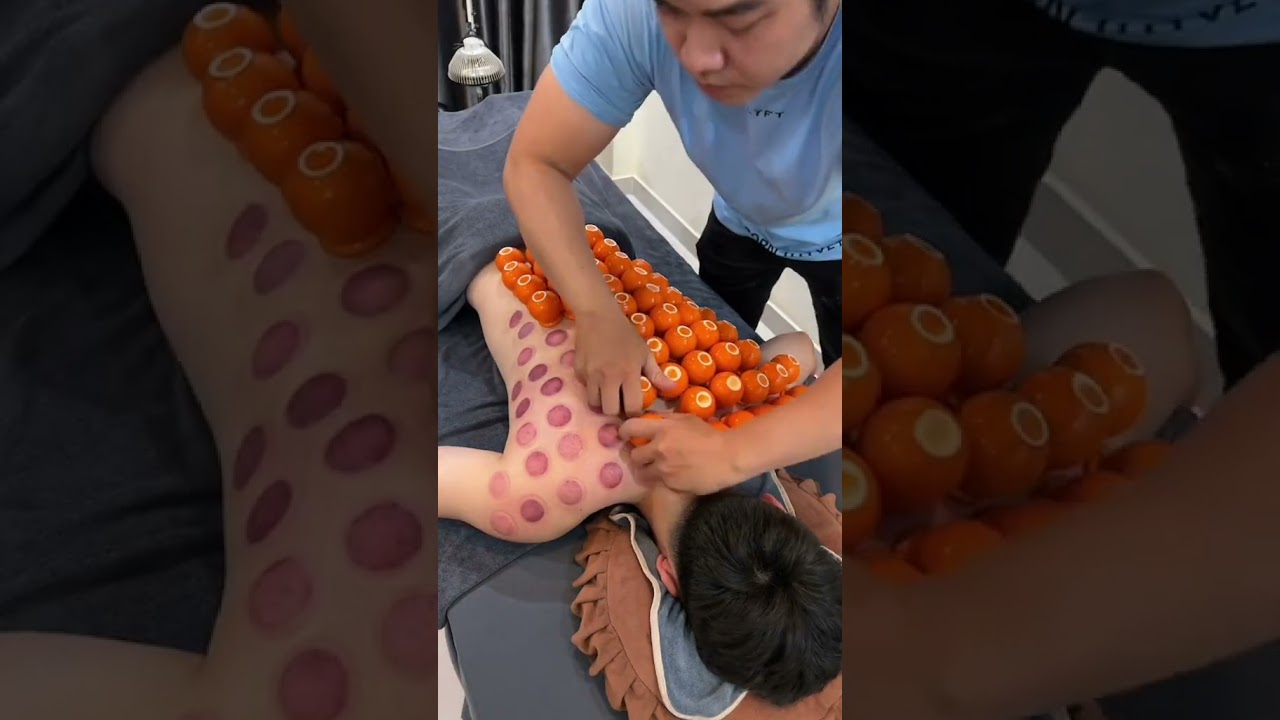 [ASMR] Cupping Therapy with 80 mini cups #asmr #cupping #trilieuhaiphong #xuhuong #Giachoi