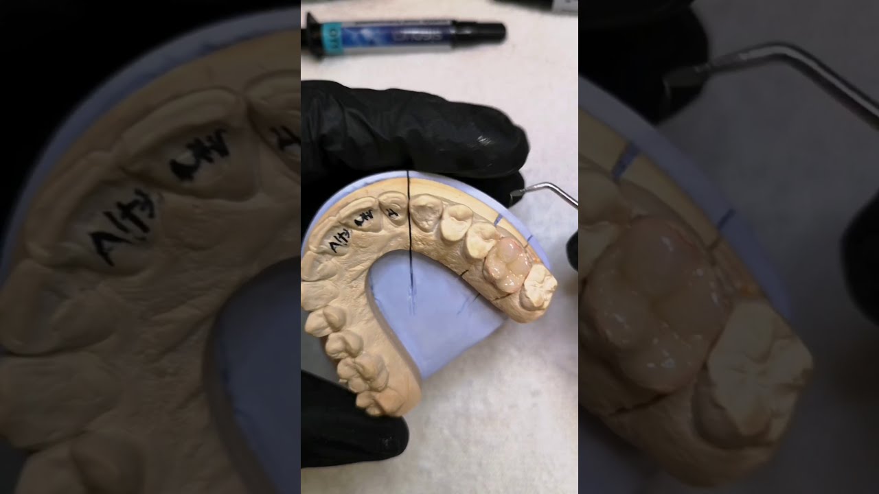 Incrustación Signum Ceramis