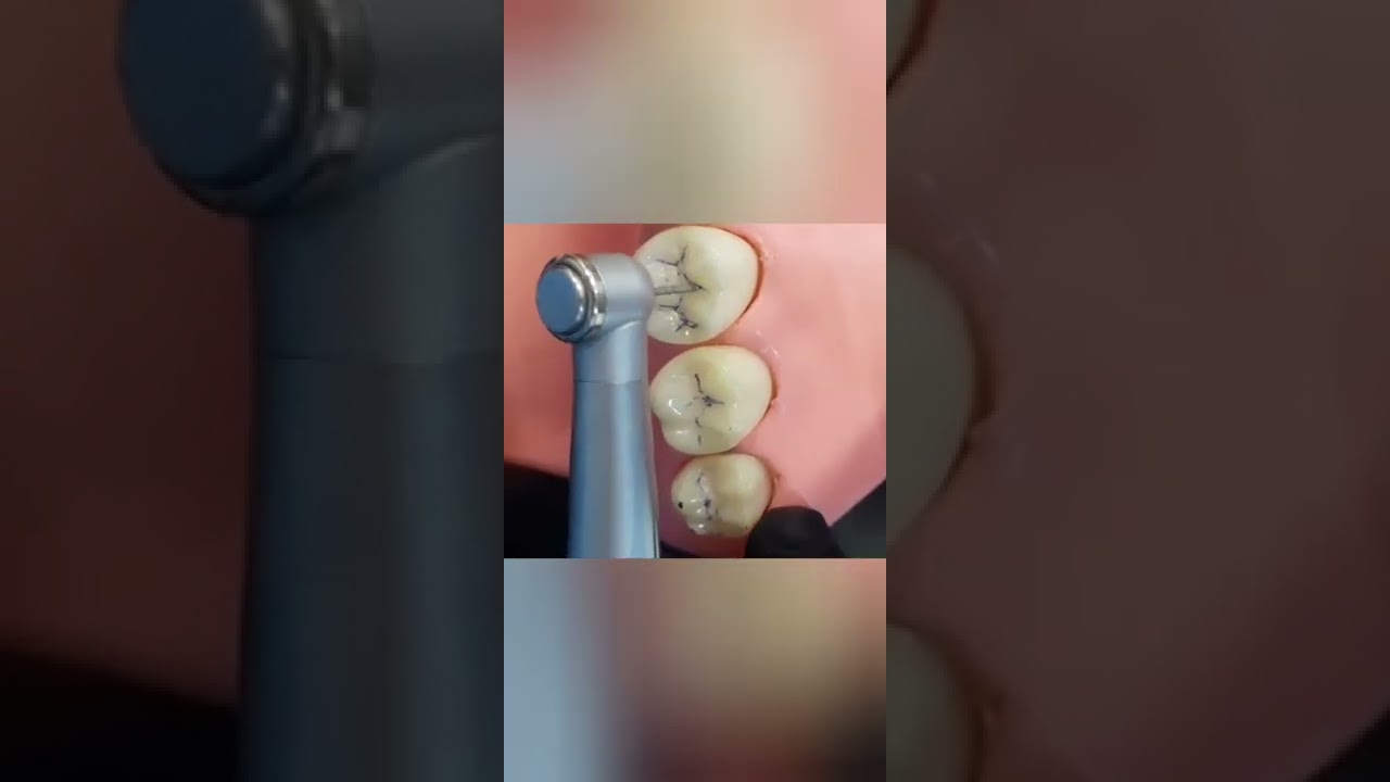 when & how , I do separation technique for tooth extraction