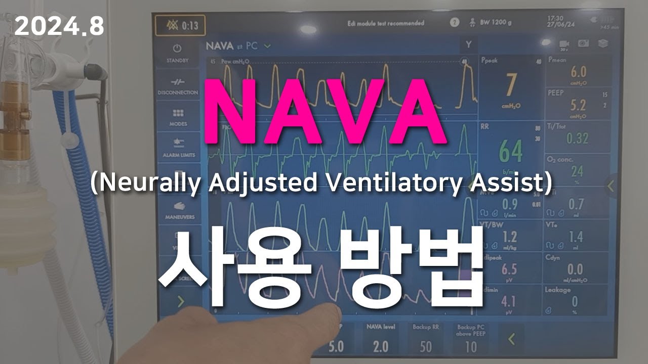 2024 NAVA 사용 방법 (나바, 신경으로 조절되는 환기 보조, (neurally adjusted ventilatory assist)