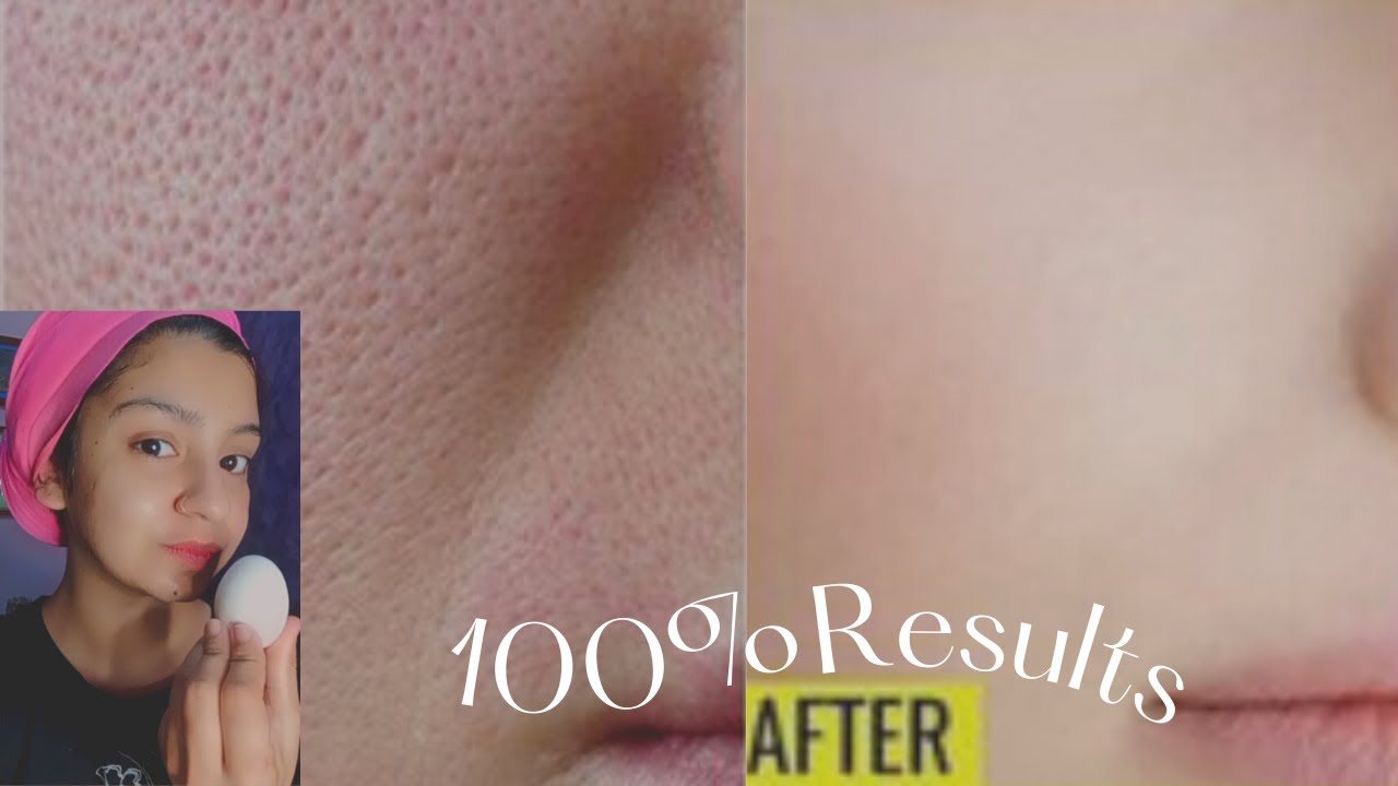 How I'm Treating My Open Pores?| Egg mask| 100% Results😍