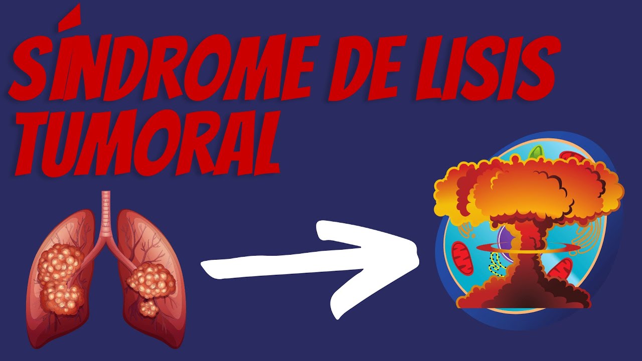 Actualización Síndrome de Lisis tumoral