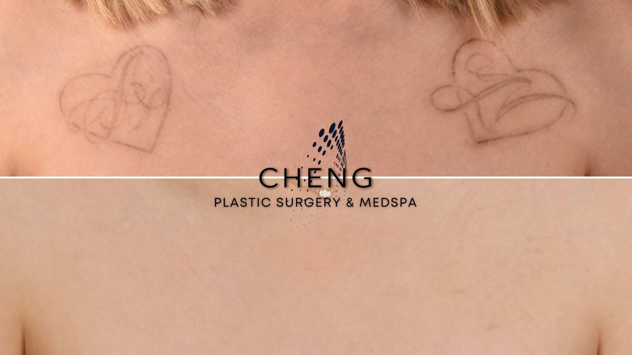 Patient Testimonial: Tattoo Removal