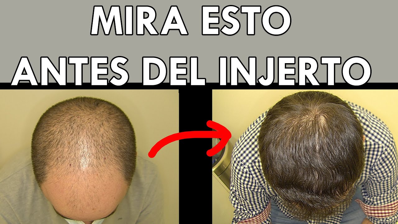Te obligo a ver este video antes del injerto de pelo (explicado por cirujano)