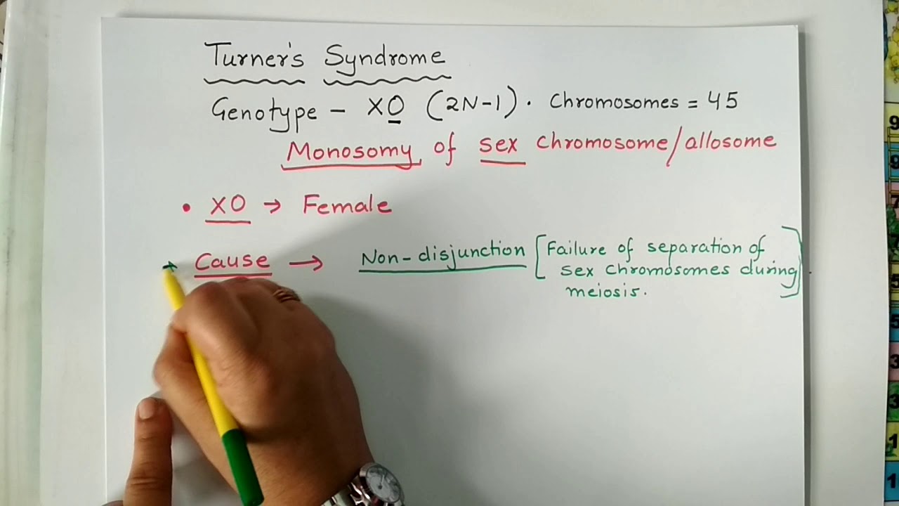 #TurnerSyndrome, #Chromosomaldisorder, #Aneuploidy. Turner's Syndrome, Chromosomal disorder.