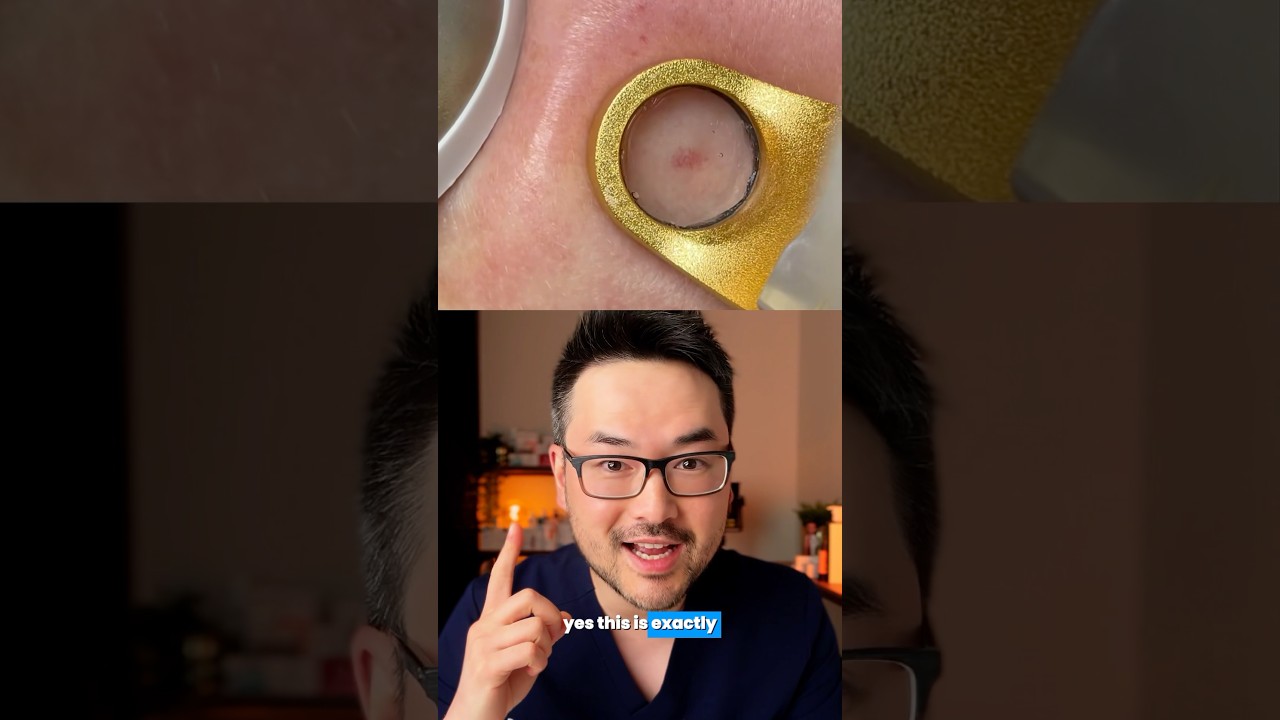 How to treat broken blood vessels 🧐 #skincare