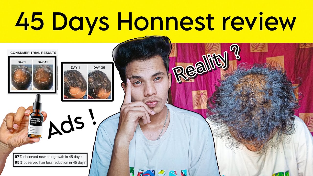 Advance Hair Growth Serum 45 Days Honest Review | सच में असर करता है या सिर्फ Marketing?