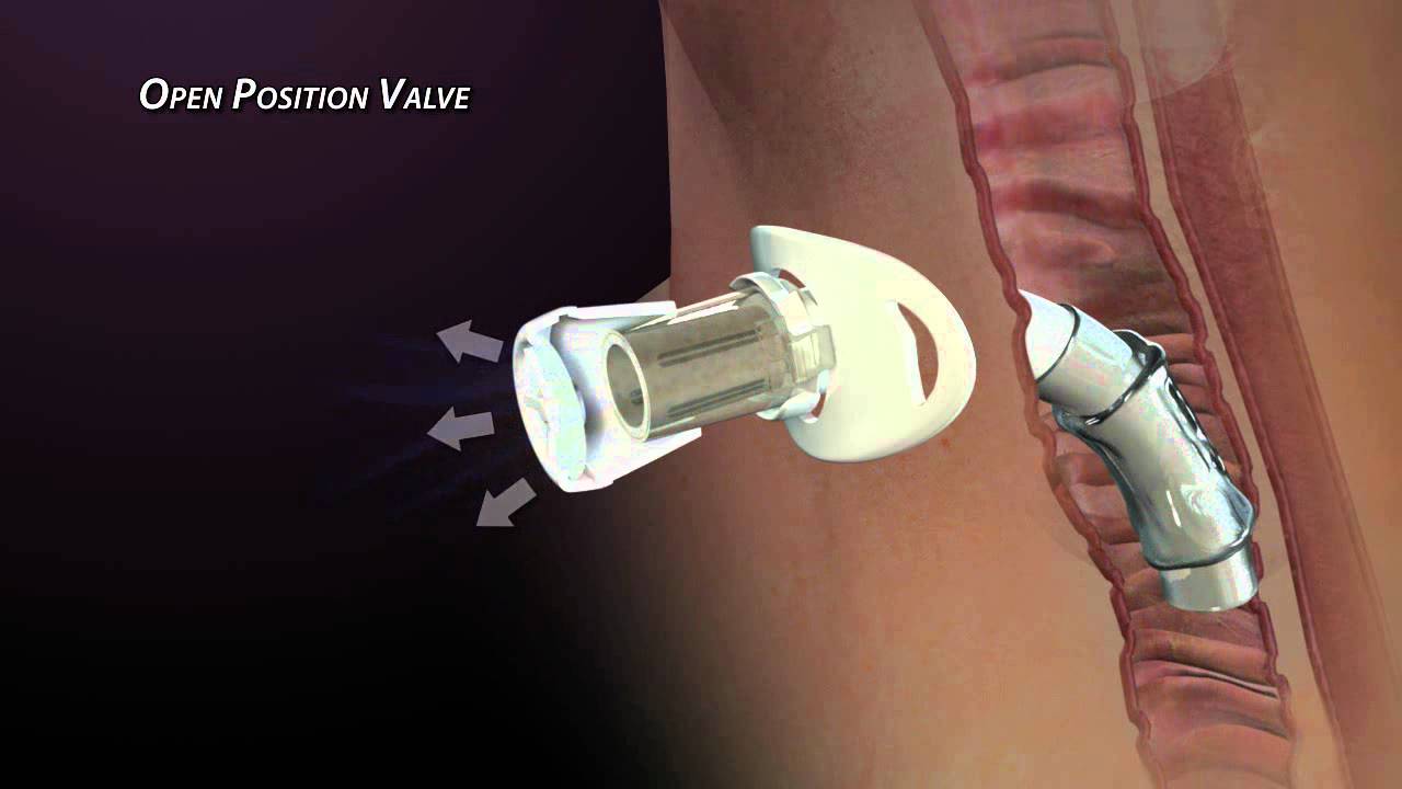 The No-Leak Design of the Passy Muir Valve
