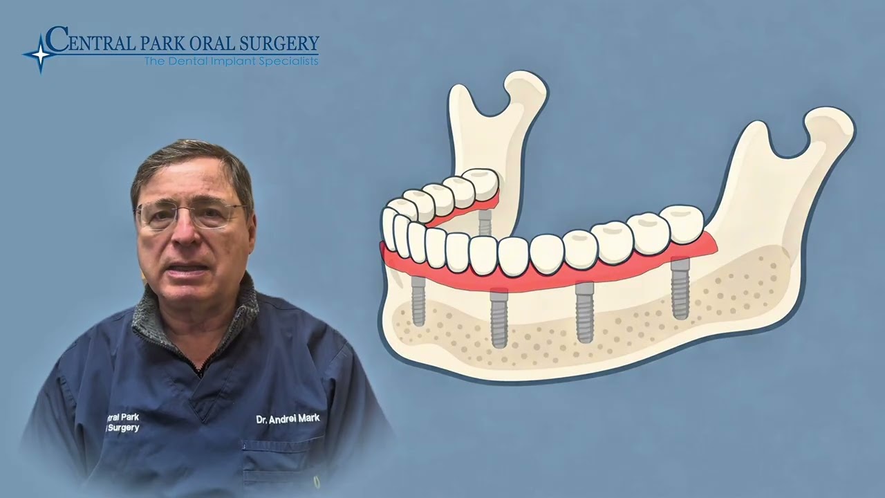Full Mouth Dental Implants NYC (All-on-4 / Full Arch)Complete smile restoration for missing teeth.