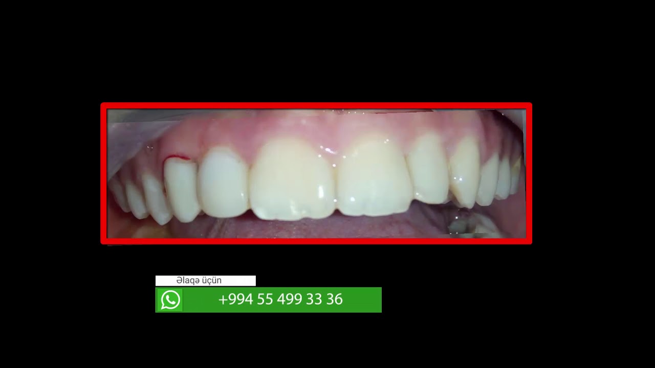 Estetik plombla restovrasiya #5 Composite Restoration