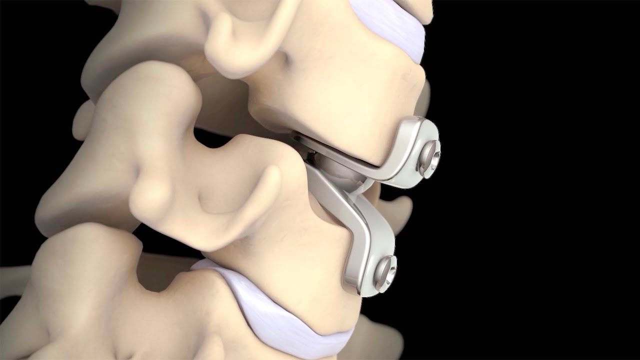 Reemplazo del disco cervical