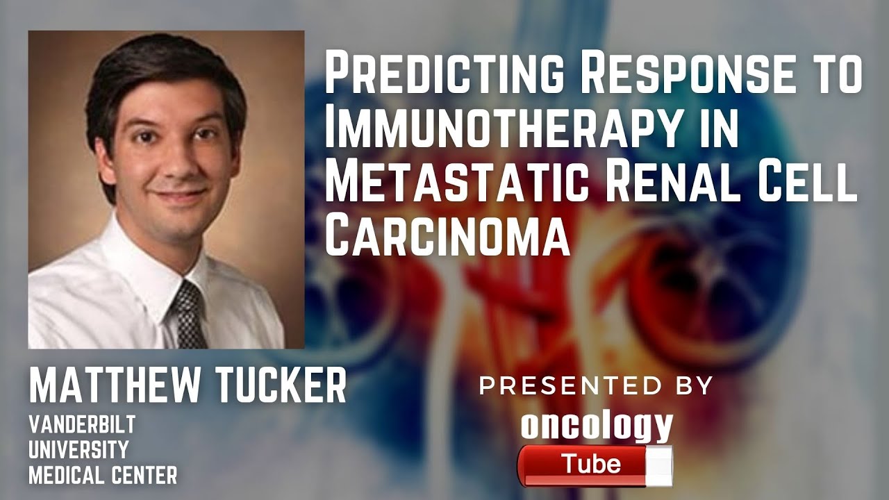 Predicting Response to Immunotherapy in Metastatic Renal Cell Carcinoma