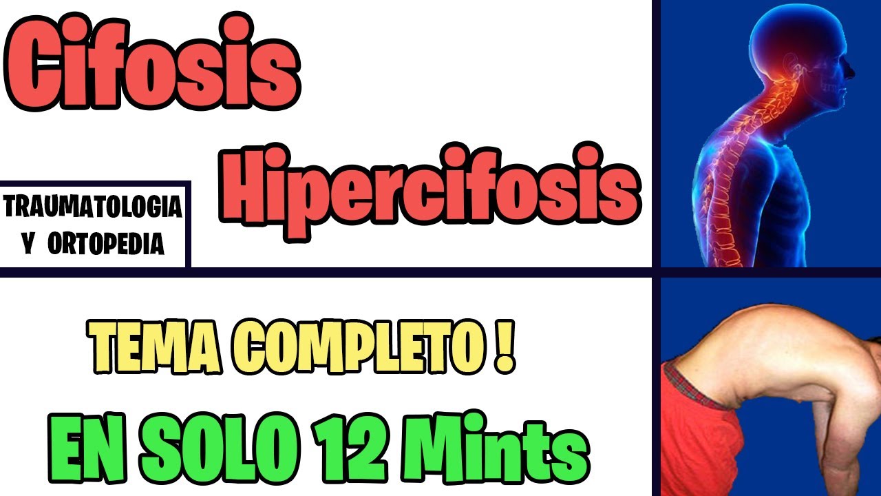 Cifosis HIPERCIFOSIS Cifosis Patológica  Mejor EXPLICADO  | ORTOPEDIA