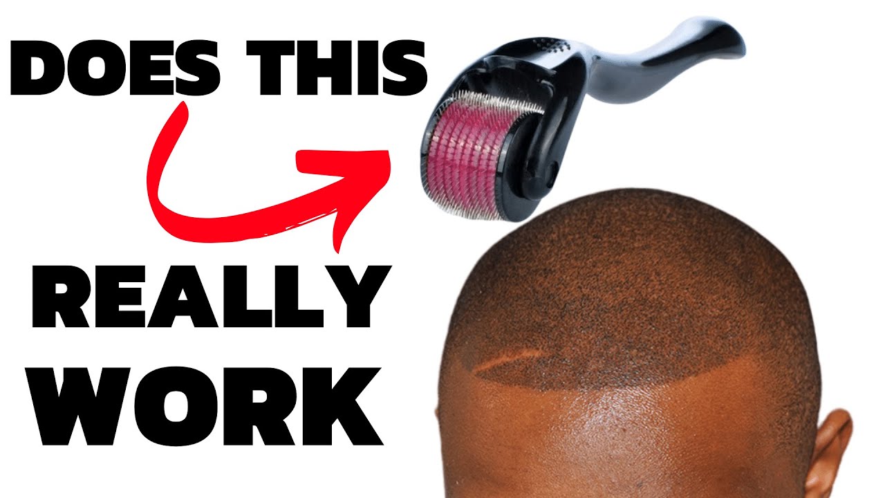 SHOCKING Derma Roller Study For Hair ReGrowth | Hair Loss