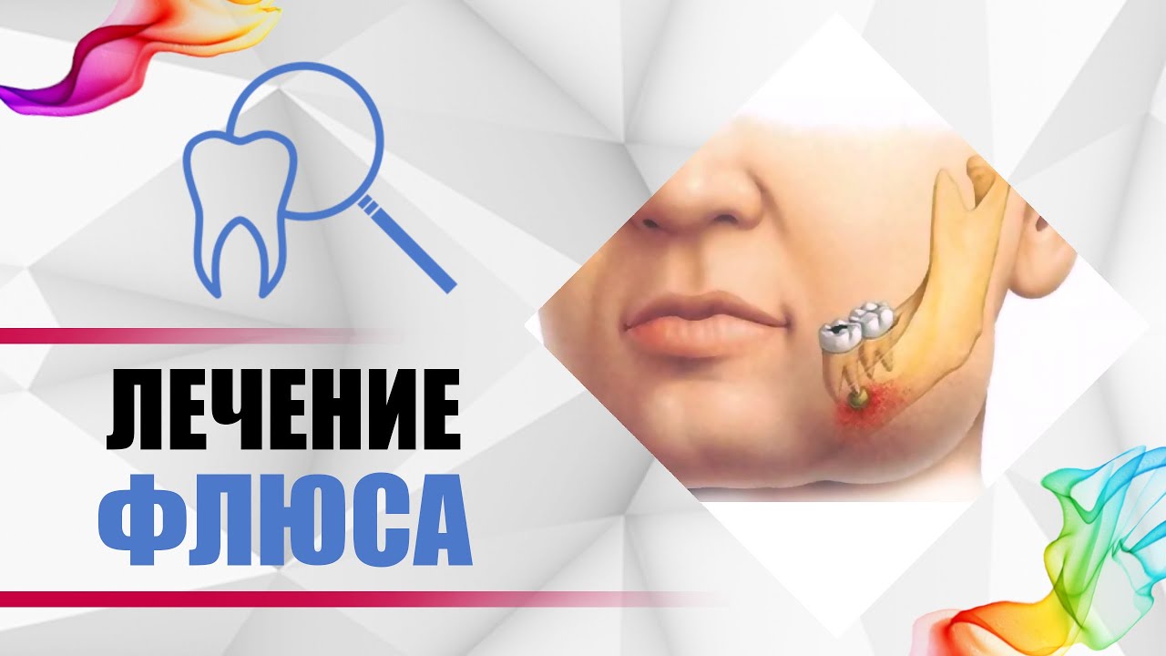 Флюс от зуба [боль, гной, отёк, абсцесс]. Развитие кариес - #пульпит - #периодонтит - #киста - #флюс