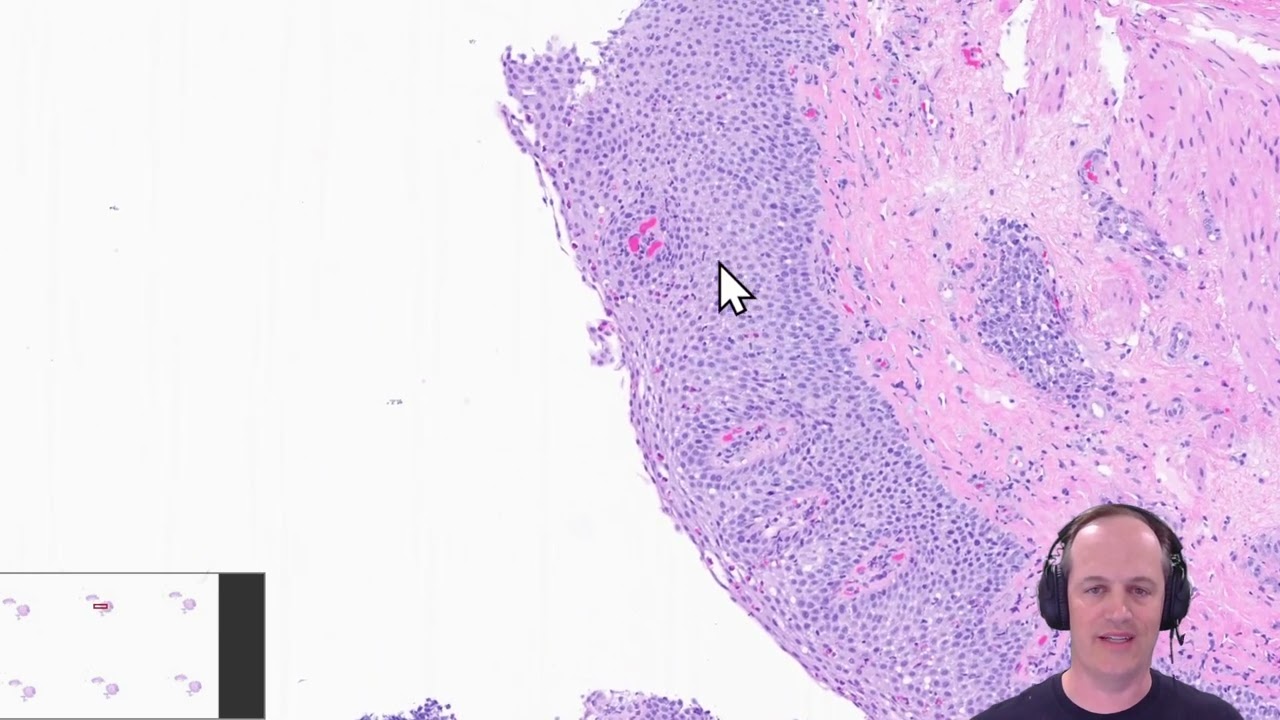 Pediatric Esophageal Biopsies