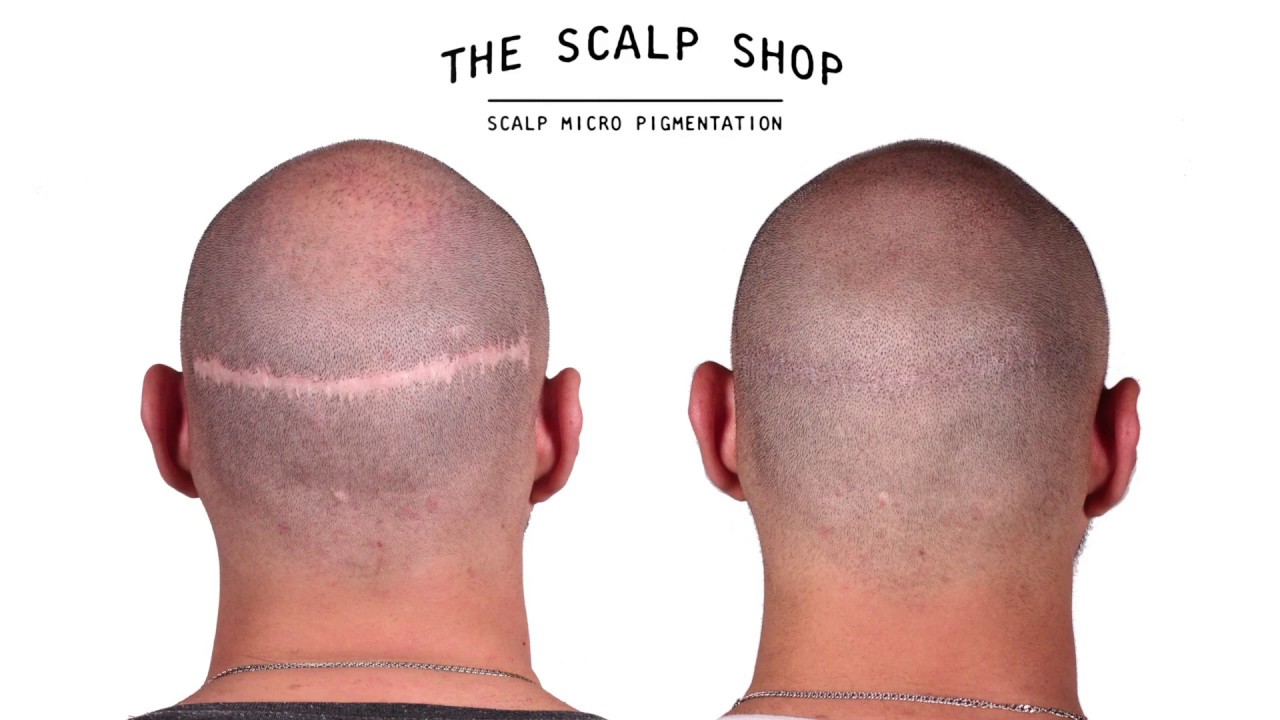 Epic Transplant Scar Camouflage With Scalp Micro Pigmentation