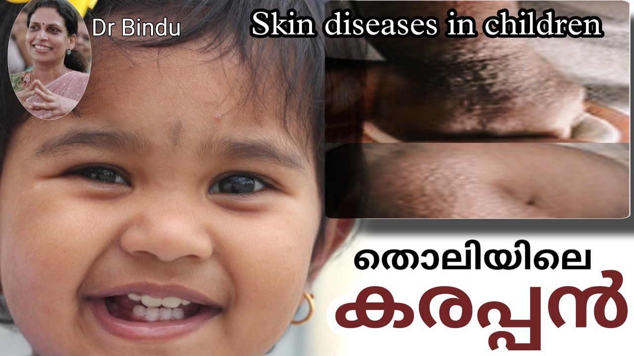 കരപ്പൻ എന്ന തൊലിരോഗം/Skin dryness/eczema in children/childcare Dr Bindu 