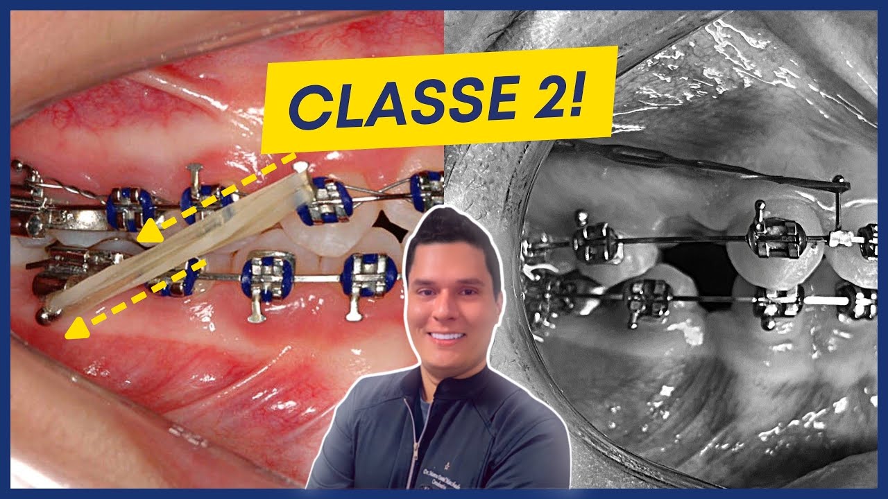COMO TRATAR A CLASSE 2 EM ORTODONTIA? ELÁSTICOS OU EXTRAÇÕES?