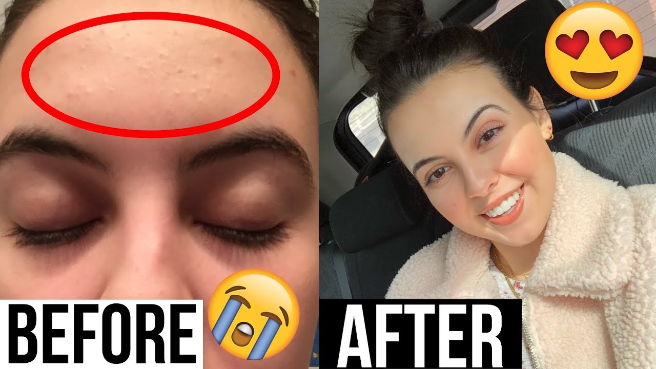 Easy Skincare Routine 2019💦| How I cleared my acne prone skin | Erika Beck