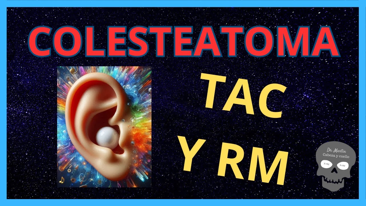 COLESTEATOMA (adquirido): HALLAZGOS RADIOLÓGICOS