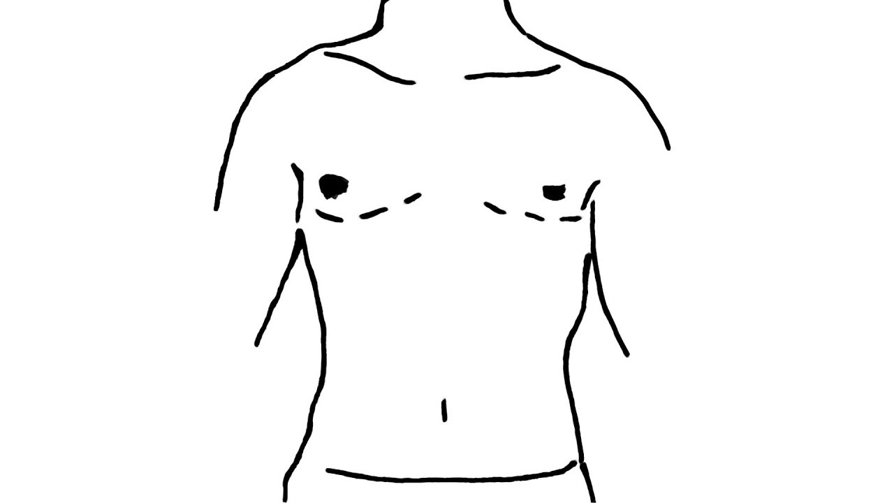 Post Op - My Top Surgery and Those Who Came Before Me