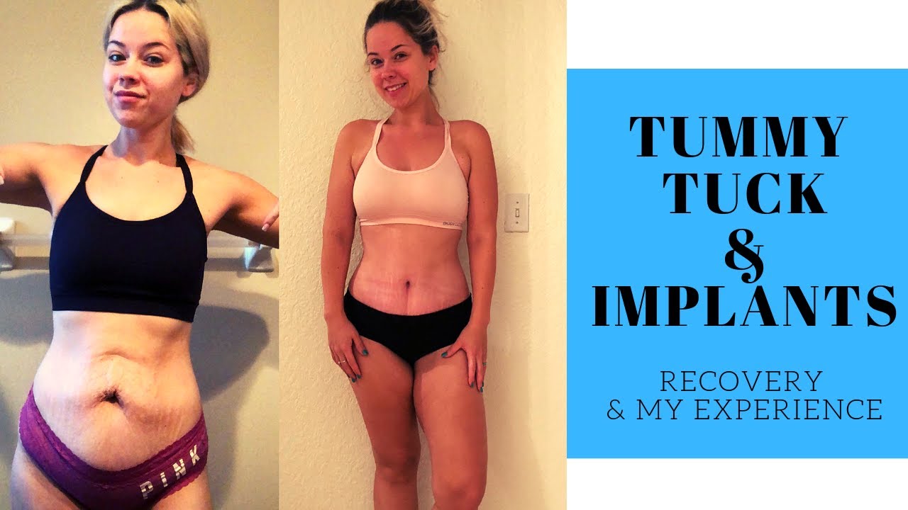 Tummy Tuck Recovery - Breast Lift and Implants - After Losing Almost 100 Pounds