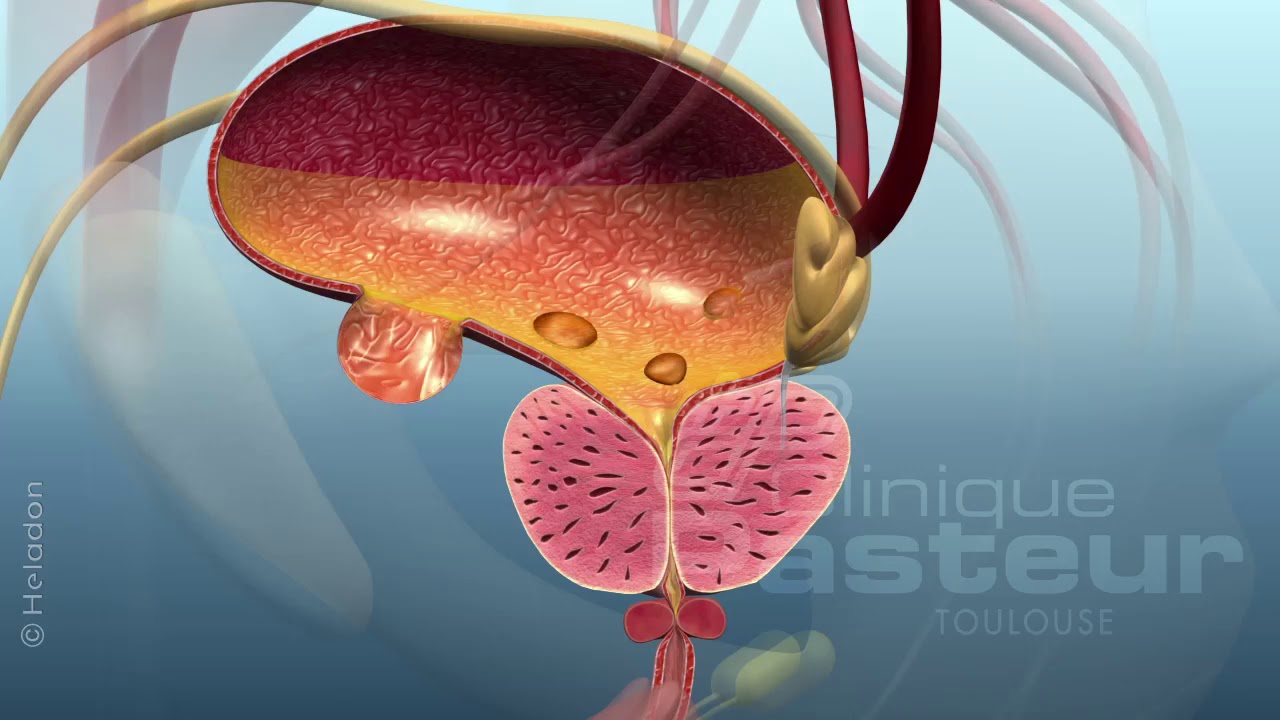 PROSTATE adenome traitement chirurgical LASER RTUP