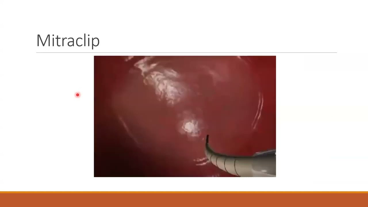 transcathetere mitral valve interventions