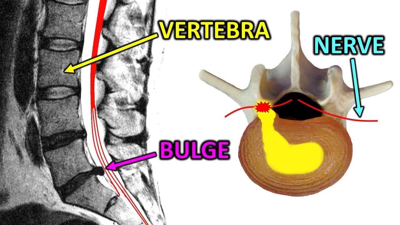 Are All Herniated Discs Bad?? Lumbar MRI Results Explained.