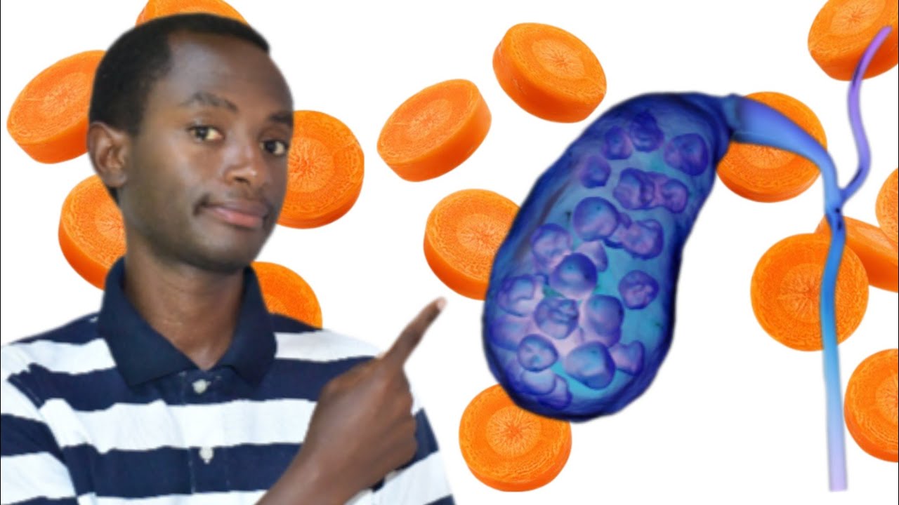 Ibimenyetso biranga ko agasabo k'indurwe kuzuyemo amabuye. (gallstones). Uko wabigenza ngo wirinde.