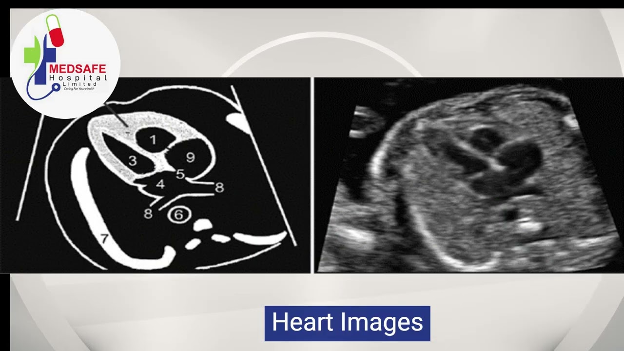 Mid Trimester Scan