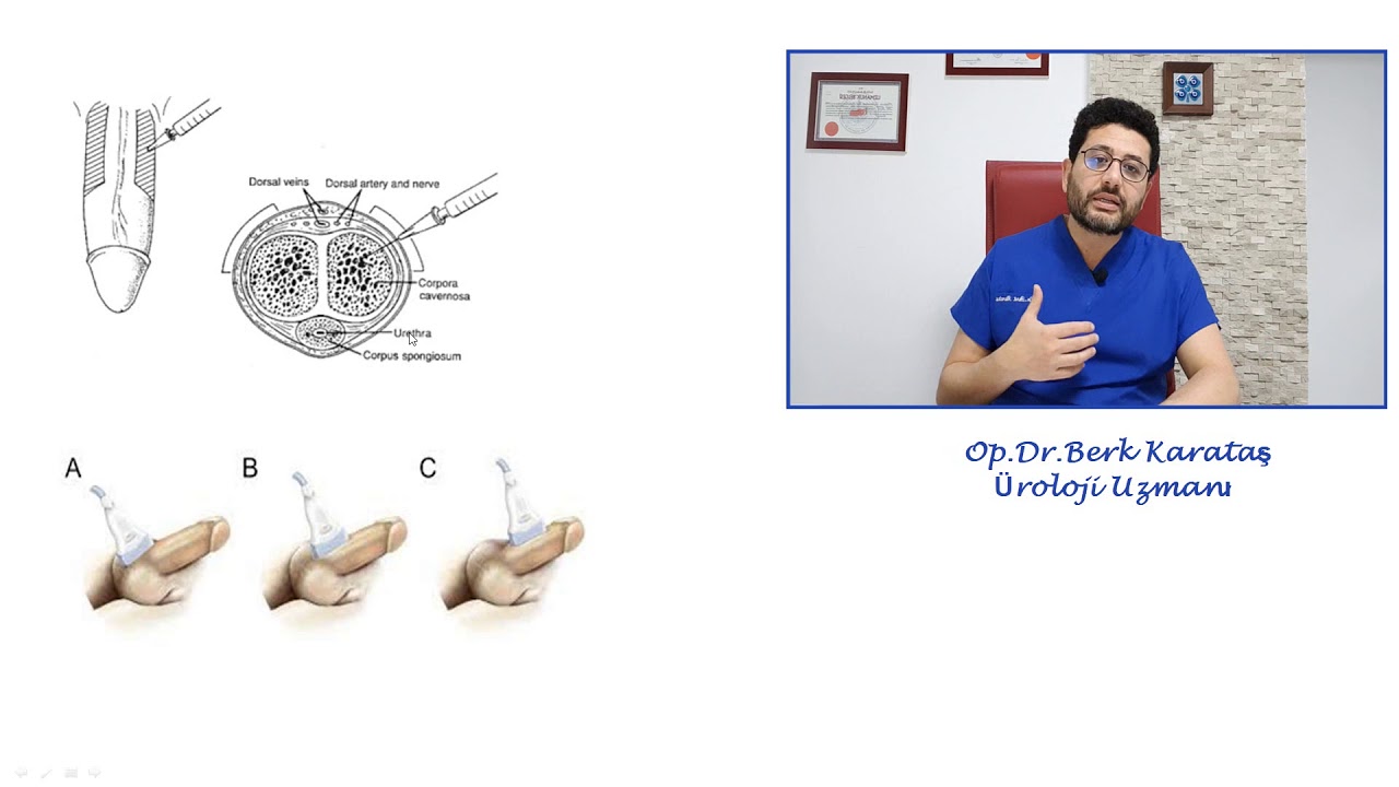 Penil Renkli Doppler Ultrasonografi Nedir ve Kimlere Yapılmalıdır ?
