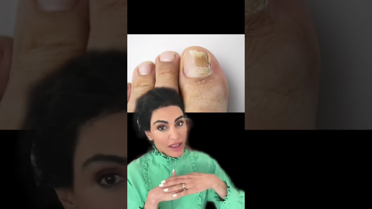 Грибок ногтей 