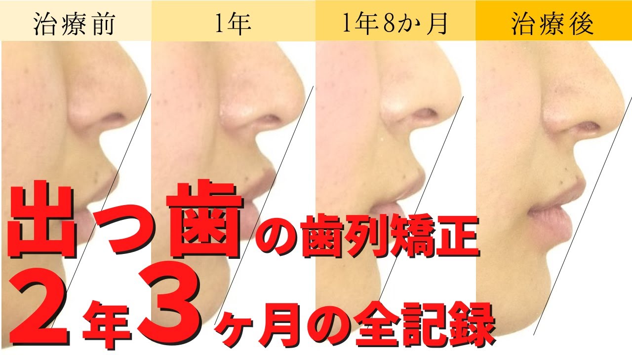 【矯正・Eラインに対する口元の変化・出っ歯】抜歯ワイヤー矯正治療例│上顎前突│ projecting teeth/buckteeth│音声解説付き