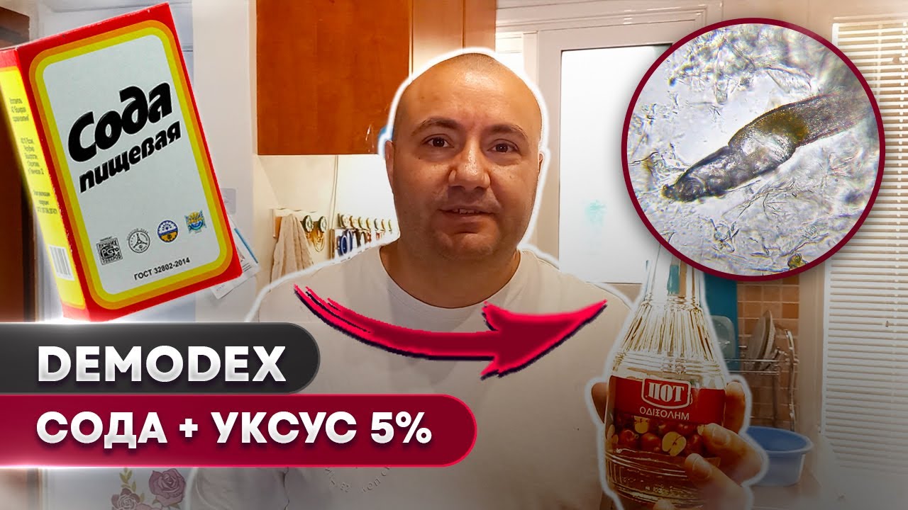 🐜 Сода против демодекса – сможет ли она убить клеща? 🔬🫧 # 1