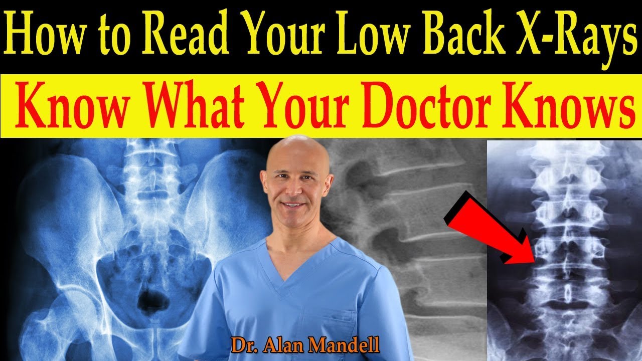 How to Read Your Low Back X-rays (Know What Your Doctor Knows) - Dr. Alan Mandell, D.C.