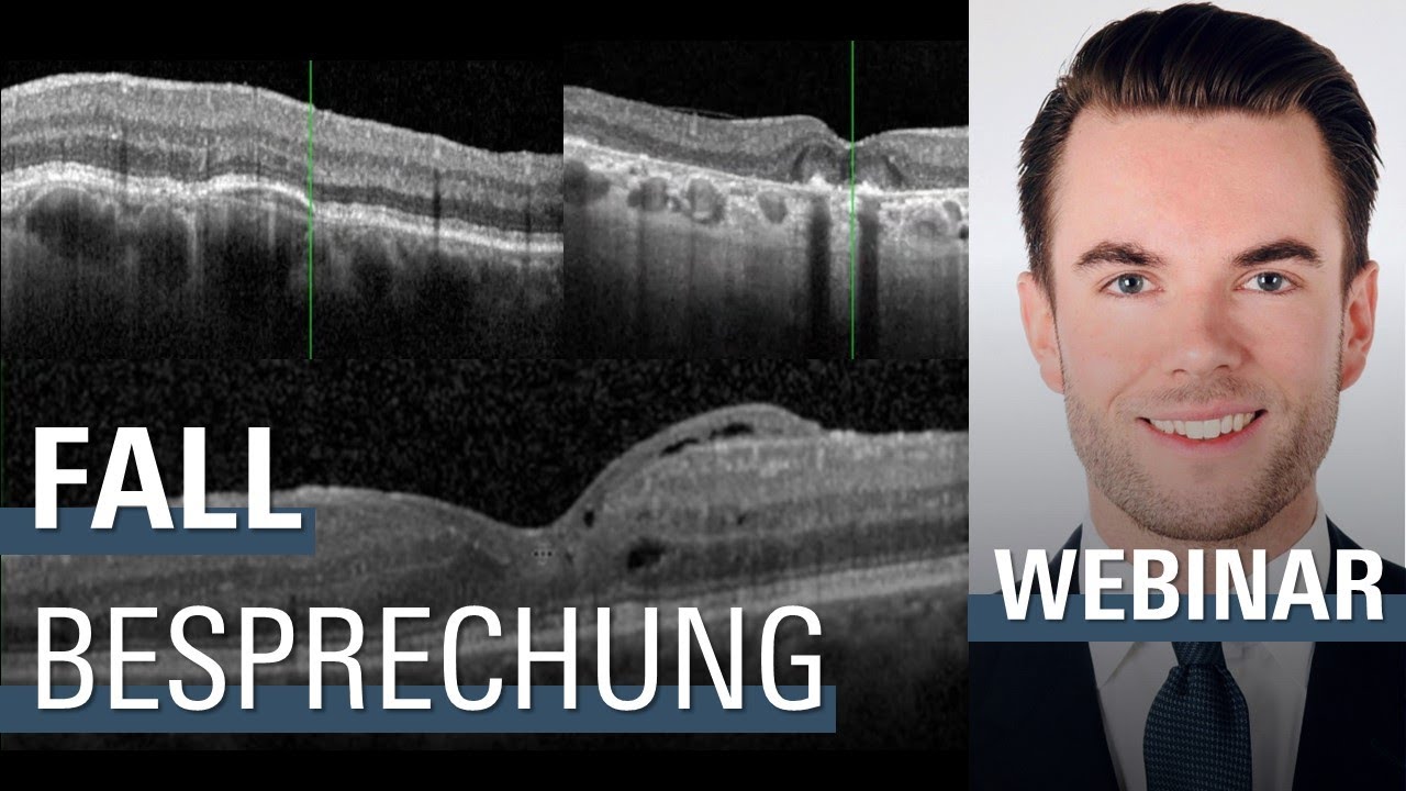 🇩🇪 2. Retina Sprechstunde: Fallbesprechung | SPECTRALIS