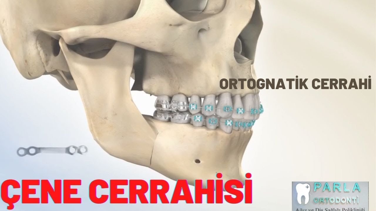 Ortognatik Cerrahi / Çene Cerrahisi / Animasyon