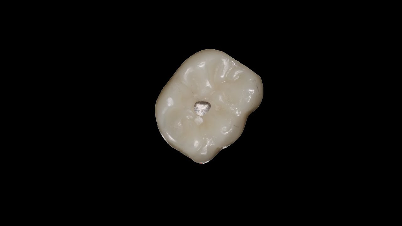 ADITAMENTOS PROTESICOS PARA CORONAS ATORNILLADAS  | Coavi formación académica