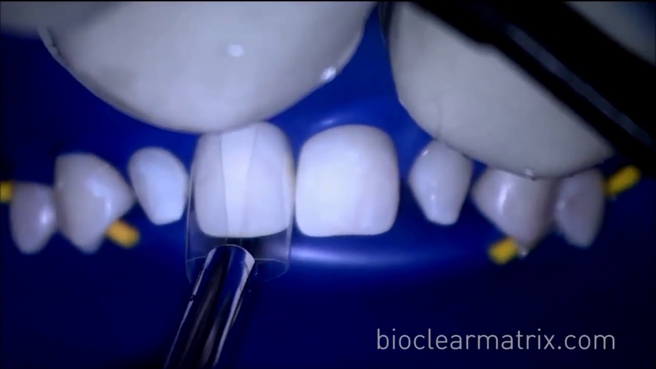 Post orthodontic undersized teeth Part 1 Bioclear Matrix
