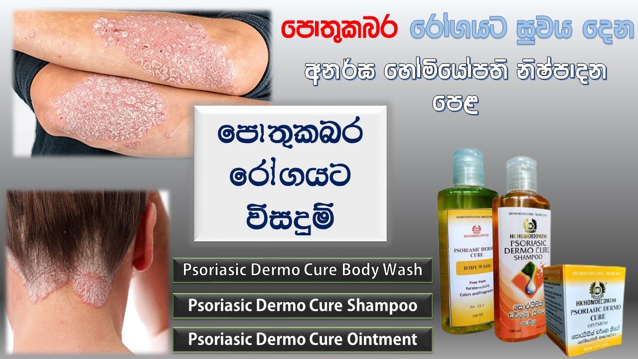 පොතු කබර රෝගය   සුව කිරීමට  හෝමියෝපති ප්‍රතිකාර - Dr Anusha Hemakumara - 2022.01.06